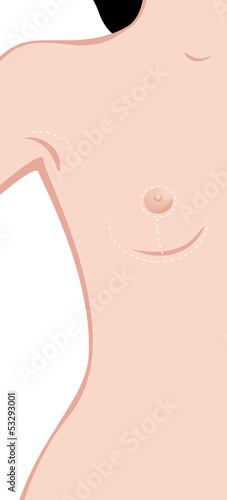 breast enlargement