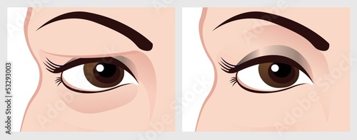 Baggy eyes. Vector image of eye before and after.