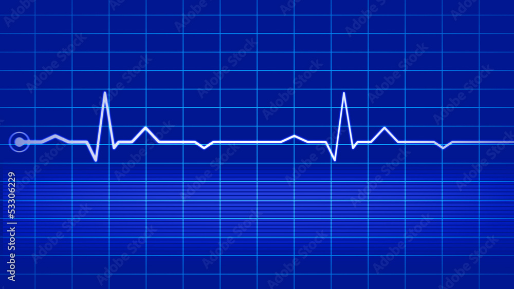 Electrocardiogram on blue monitor Electrocardiogram on blue monitor