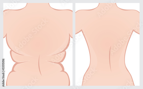 Fat back before and after treatment. Vector illustration.