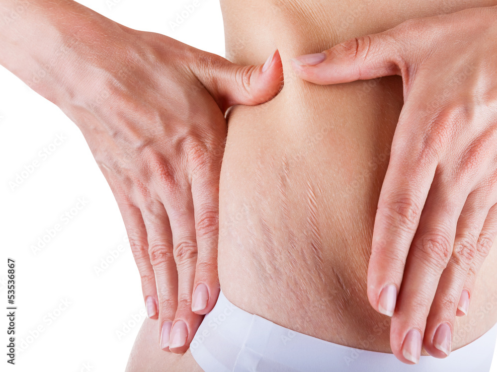 Fotografie Stretch marks