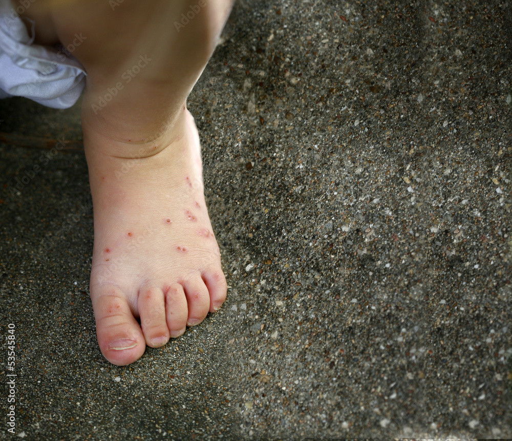Child's feet with ant/ mosquito bites allergy Stock Photo Adobe Stock