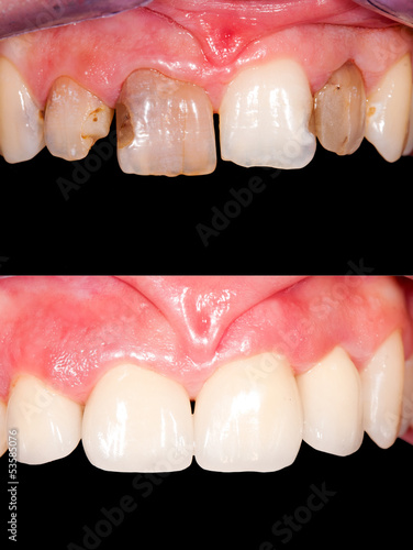 Dental restoration #53585076