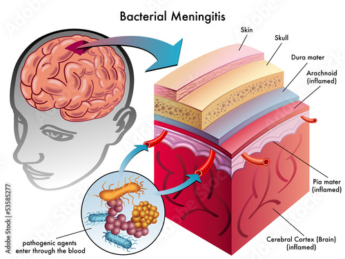 meningite batterica