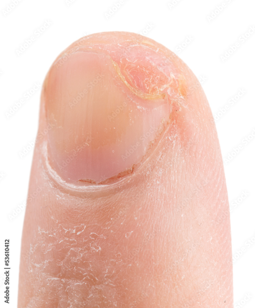 Finger cut with knife, three weeks after unjury, isolated Finger cut with knife, three weeks after unjury, isolated