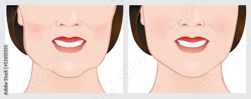 Face lift using dermal fillers, before and after