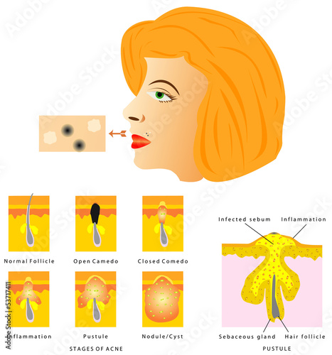 Formation of skin acne
