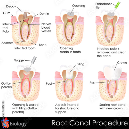 Root Canal Procedure #53822465