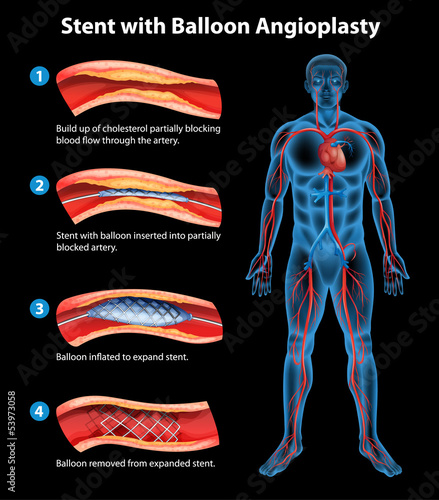 Stent angioplasty procedure