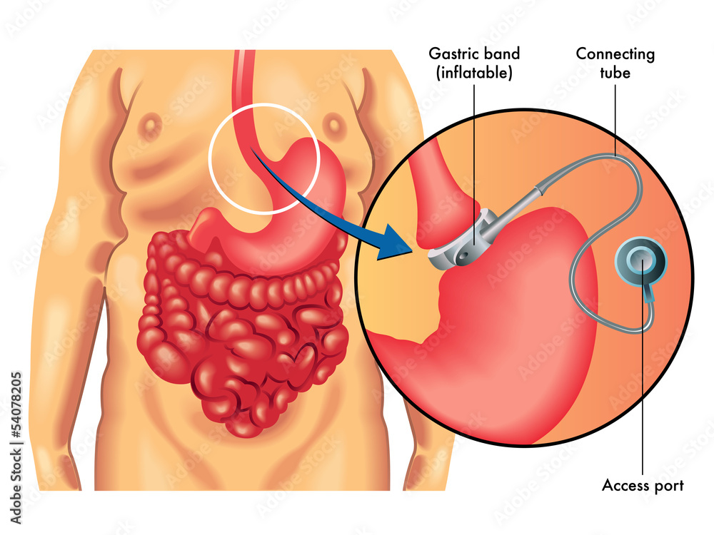 Obraz premium bendaggio gastrico regolabile