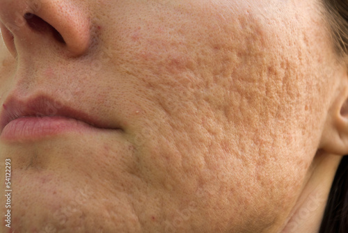acne scars photo