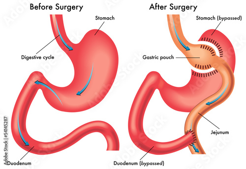 Bypass gastrico