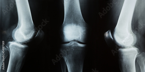 Quadro em tela x-ray photo of a human knee