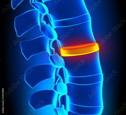 Disc Degeneration - Spine problem photo