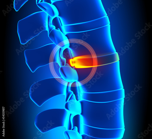 Bulging Disc Degeneration - Spine problem photo