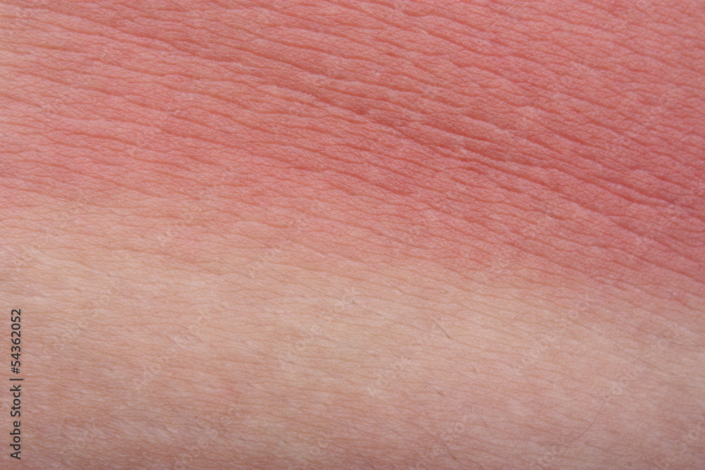 Fototapeta premium Example sunburn