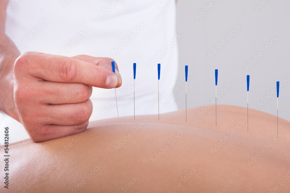 Woman Receiving An Acupuncture Therapy - obrazy, fototapety, plakaty 