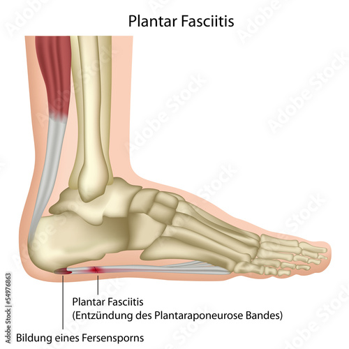 Plantar fasciitis, vector illustration german