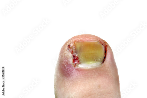 Ingrown toenail