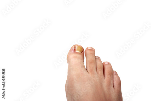 Photos Removed ingrowing toe nail