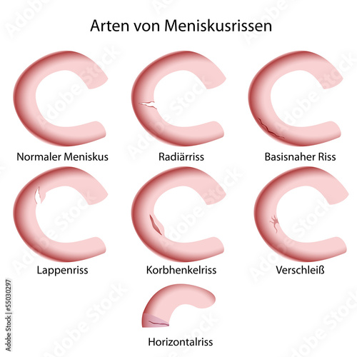 Arten von Meniskusverletzungen