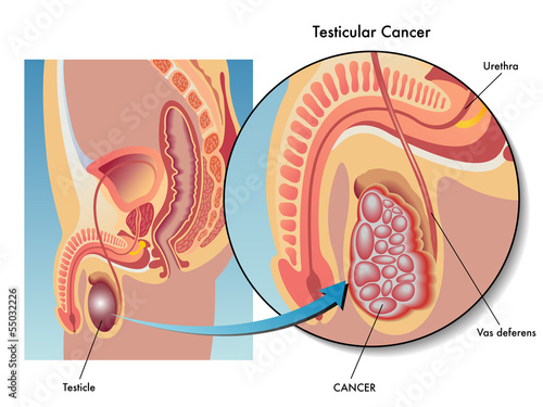 cancro del testicolo