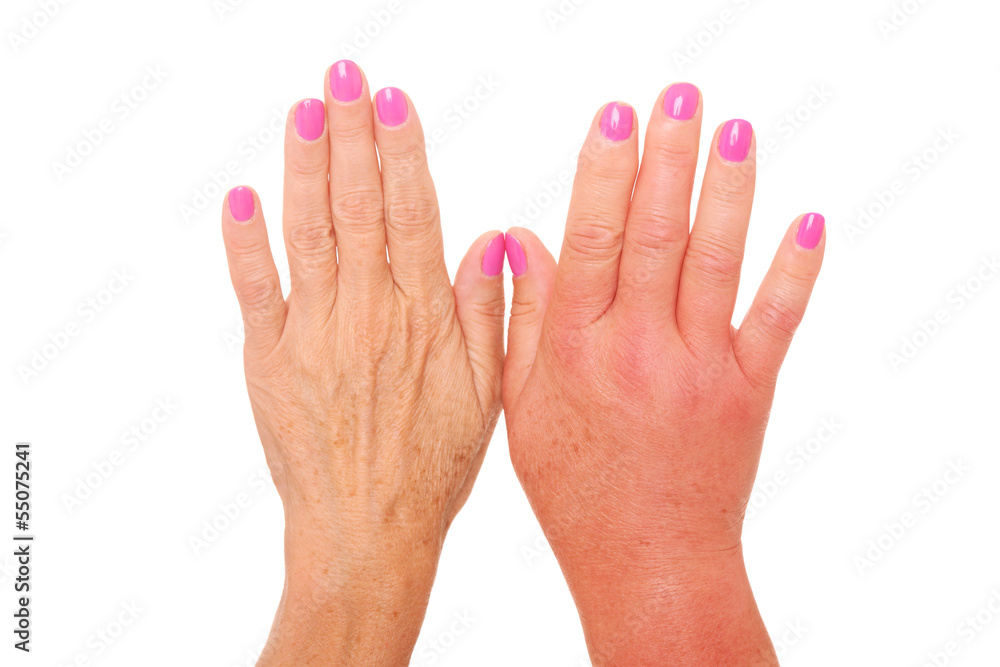 Swollen hand Stock Photo Adobe Stock