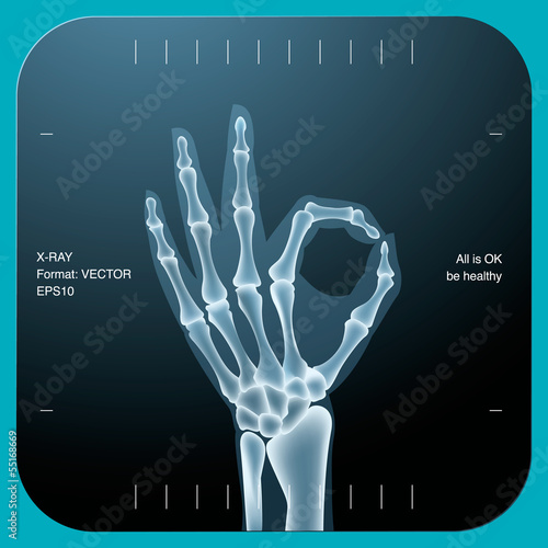 X-ray of both human hand (OK!), vector Eps10 illustration.