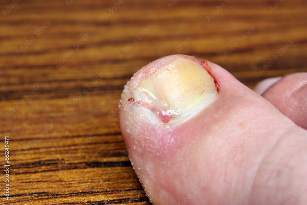 Obraz premium Toe after surgery