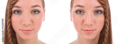 Photos Close-up of teenager face with and without acne