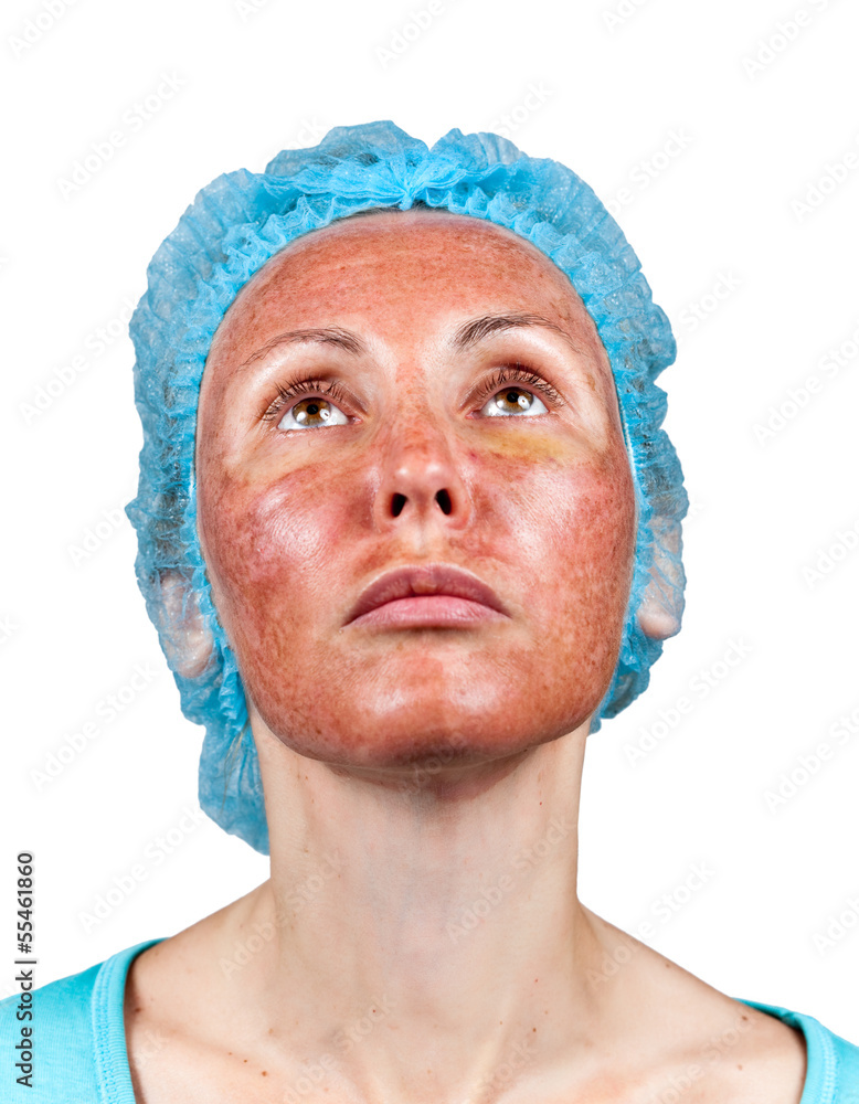 Cosmetology.Chemical peeling.Boundary between processed Cosmetology.Chemical peeling.Boundary between processed