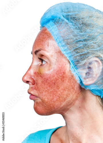 Cosmetology. Skin condition after chemical peeling TCA photo