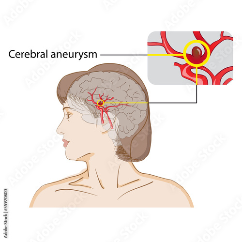 Cerebral aneurysm photo