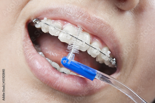 Brushing your teeth with braces