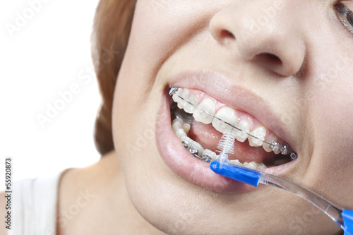 Teeth and braces.