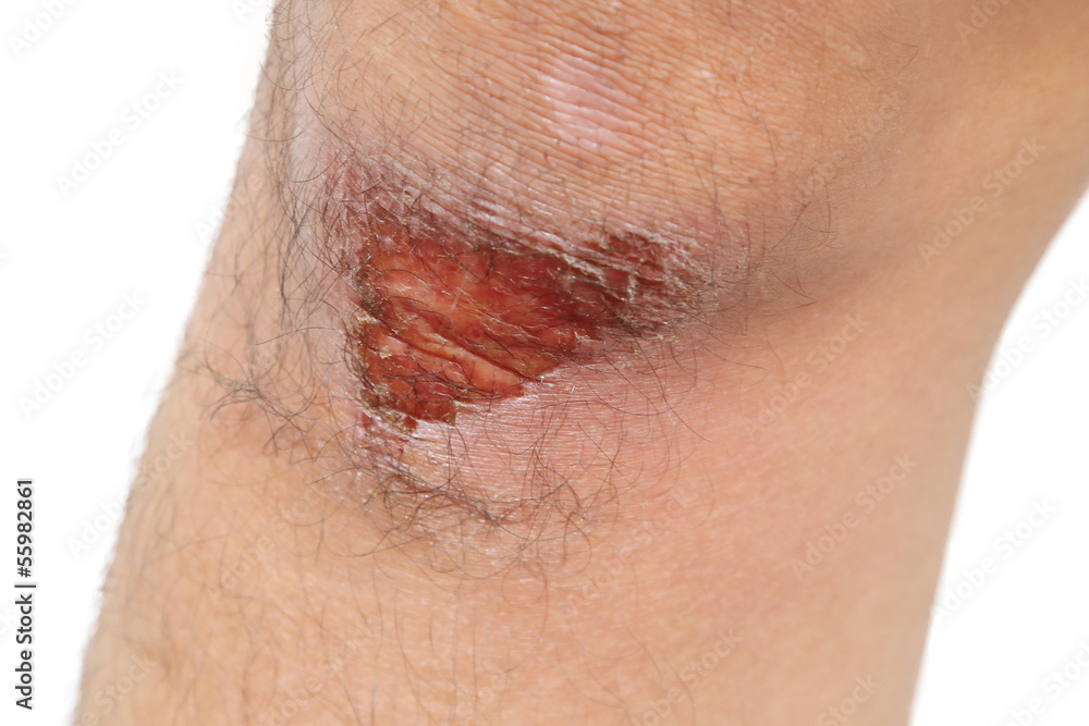 Fototapeta premium isolated wounded knee