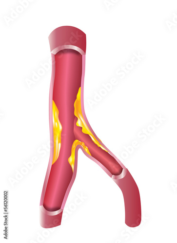 cholesterol in artery