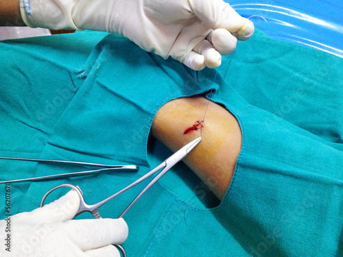 suture wound