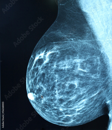 Mammogram radio imagingr breast cancer diagnosis