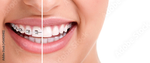 Healthy smile with braces photo