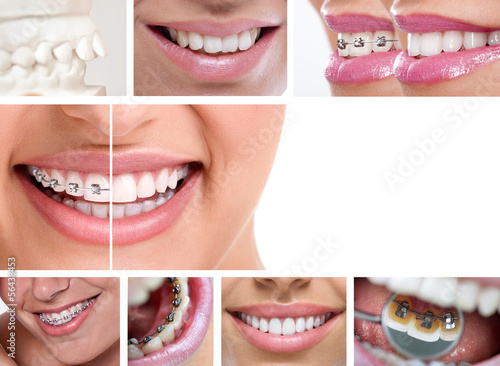 dental braces #56438453