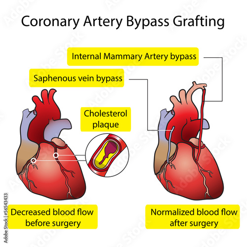 Coronary Artery Bypass