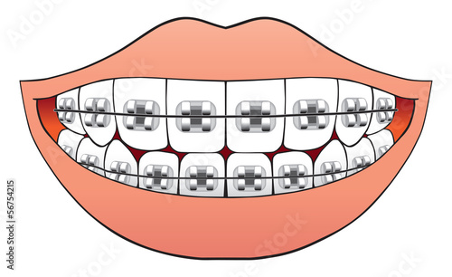 Teeth with braces