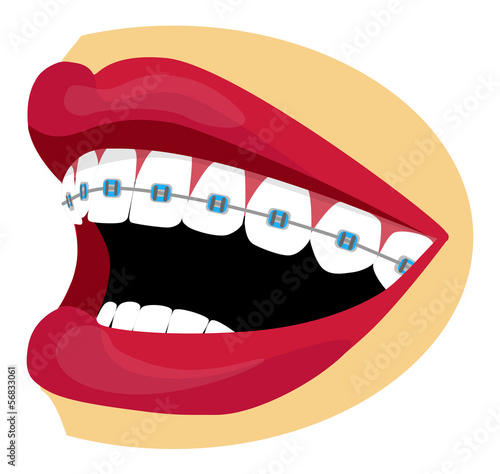 Braces illustration