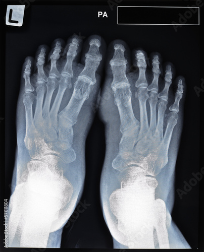 an x-ray of mature man's feet. © varandah