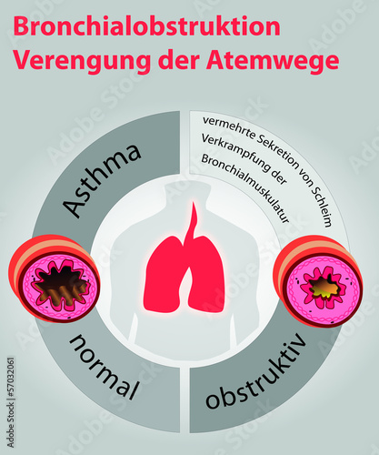 Asthma-Bronchialobstruktion
