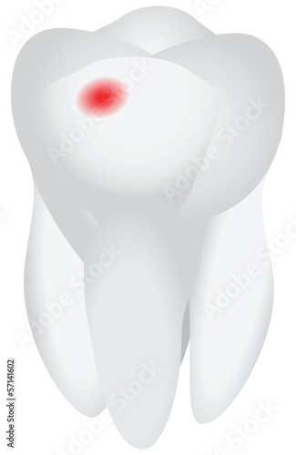 Caries