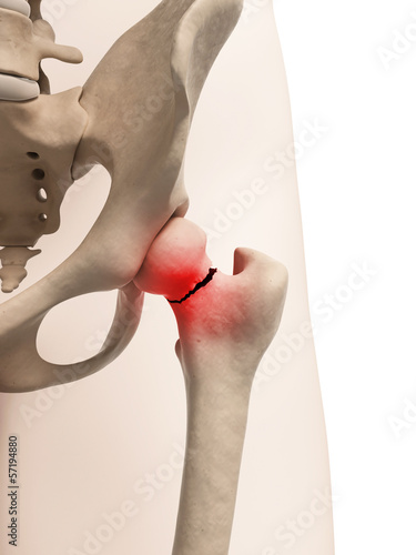 Canvas Print medical illustration of broken hip