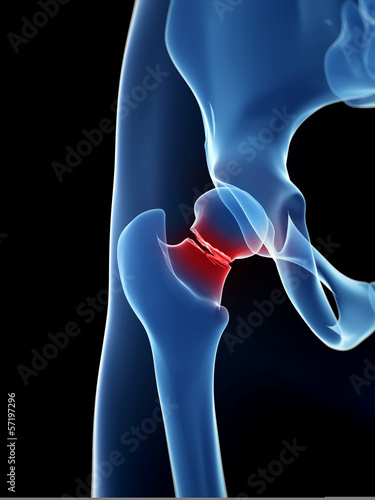 medical illustration of broken hip