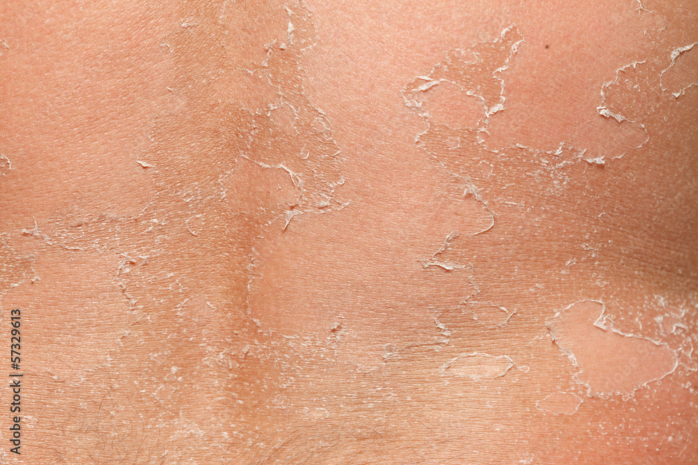Part of peeling back Part of peeling back